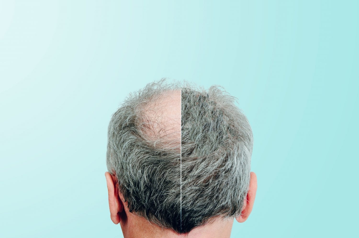 Hair Loss Treatment with PRP Injections - Virginia, and Maryland